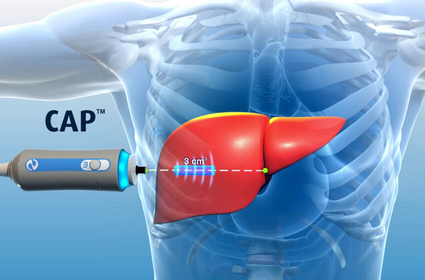  Fibroscan: A New and Simple Method for Early Diagnosis of Liver Disease