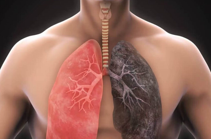  A Comprehensive Guide to Chronic Obstructive Pulmonary Disease (COPD)