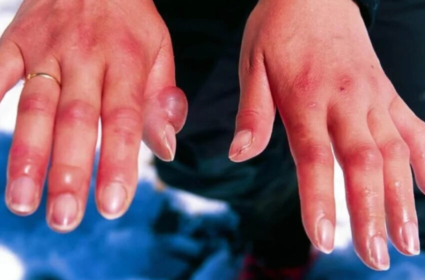  Body Freezes: A Complete Guide to Hypothermia