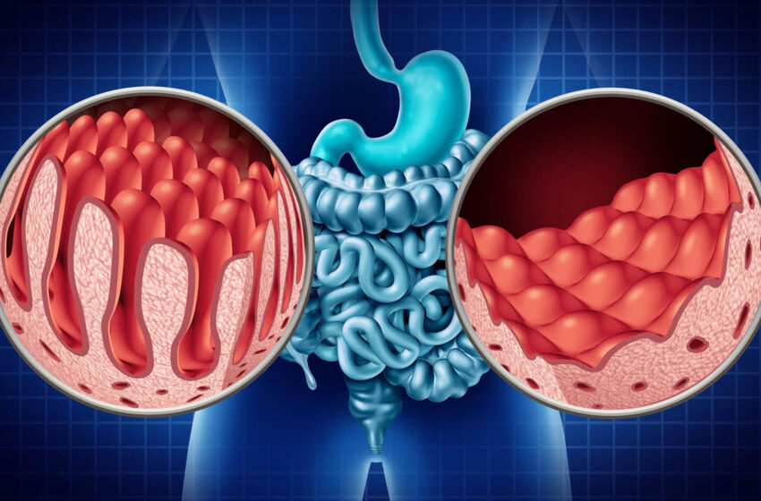  Celiac Disease: A Not So Silent Epidemic